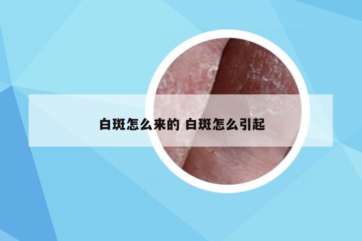 白斑怎么来的 白斑怎么引起