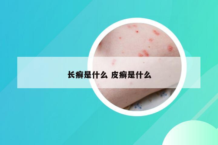 长癣是什么 皮癣是什么