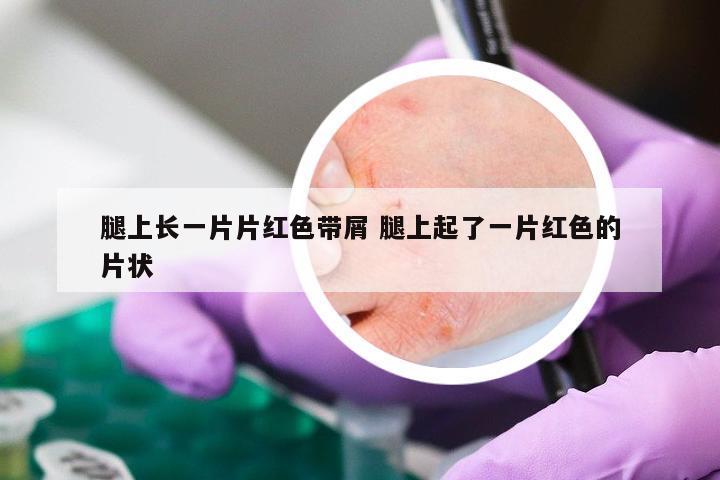 腿上长一片片红色带屑 腿上起了一片红色的片状