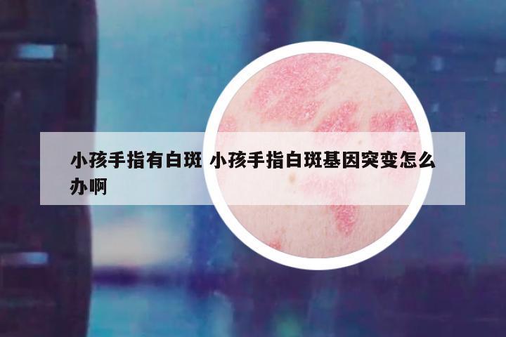 小孩手指有白斑 小孩手指白斑基因突变怎么办啊