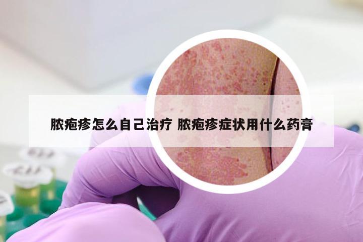 脓疱疹怎么自己治疗 脓疱疹症状用什么药膏