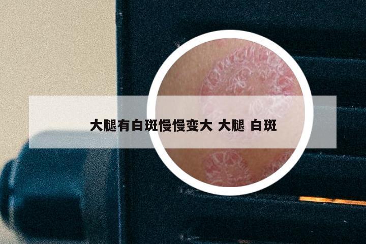 大腿有白斑慢慢变大 大腿 白斑