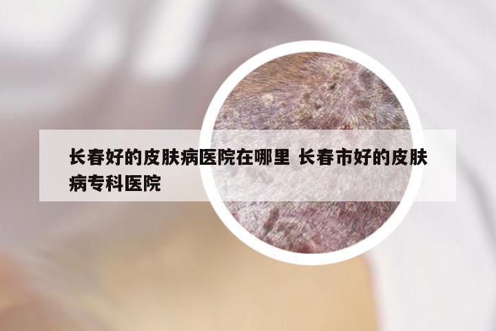 长春好的皮肤病医院在哪里 长春市好的皮肤病专科医院