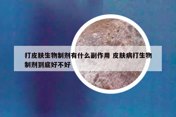 打皮肤生物制剂有什么副作用 皮肤病打生物制剂到底好不好