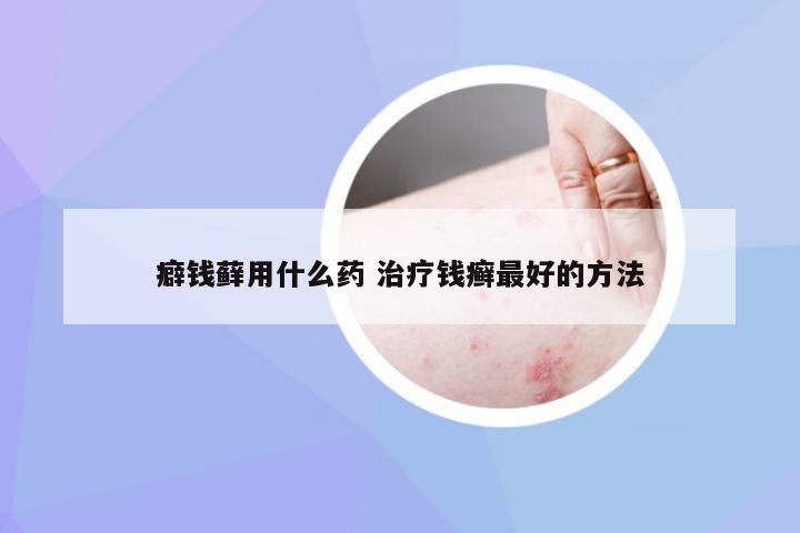 癖钱藓用什么药 治疗钱癣最好的方法