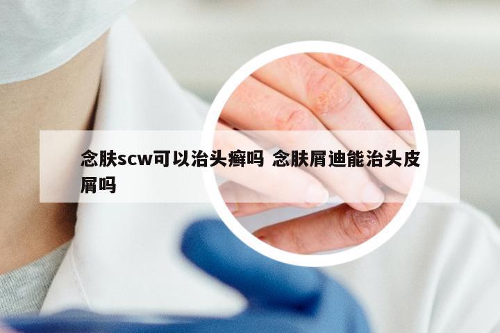 念肤scw可以治头癣吗 念肤屑迪能治头皮屑吗