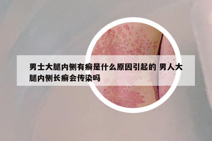 男士大腿内侧有癣是什么原因引起的 男人大腿内侧长癣会传染吗