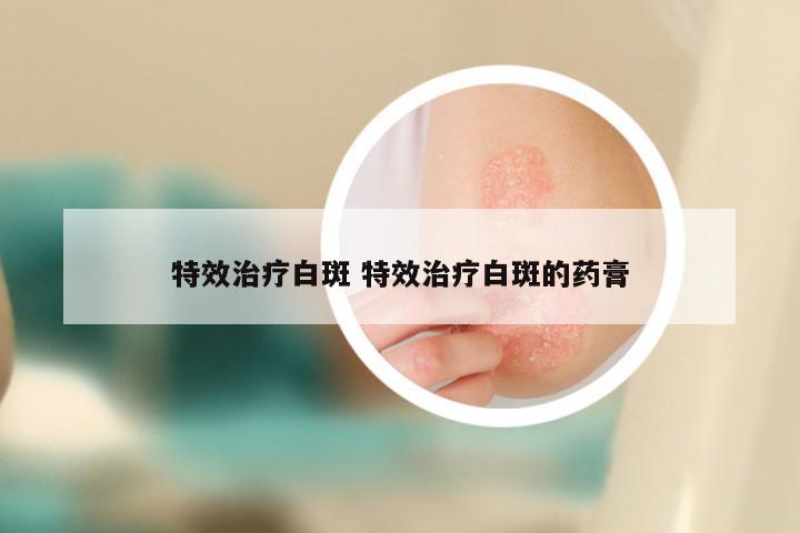 特效治疗白斑 特效治疗白斑的药膏