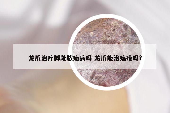 龙爪治疗脚趾脓疱病吗 龙爪能治痤疮吗?