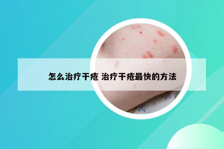 怎么治疗干疮 治疗干疮最快的方法