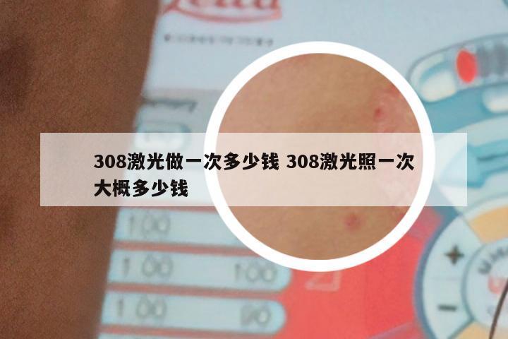 308激光做一次多少钱 308激光照一次大概多少钱