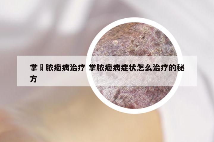 掌砋脓疱病治疗 掌脓疱病症状怎么治疗的秘方