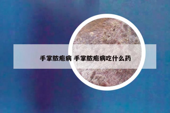 手掌脓疱病 手掌脓疱病吃什么药