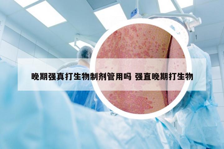 晚期强真打生物制剂管用吗 强直晚期打生物