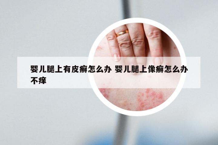 婴儿腿上有皮癣怎么办 婴儿腿上像癣怎么办不痒