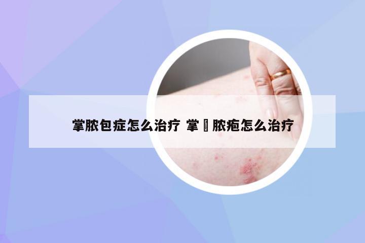 掌脓包症怎么治疗 掌砳脓疱怎么治疗