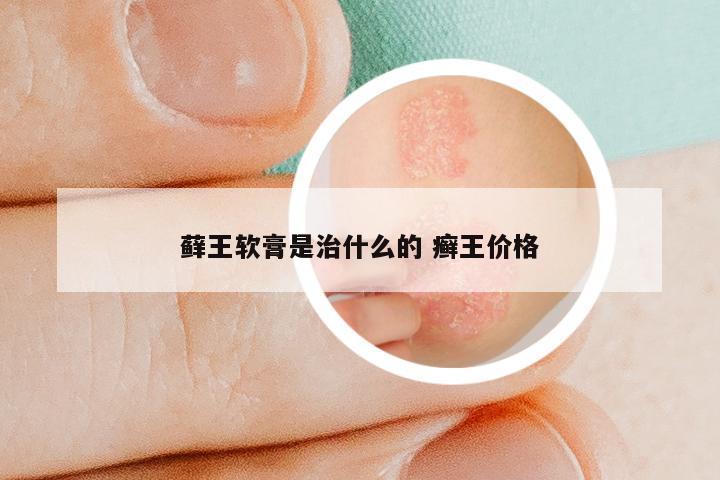 藓王软膏是治什么的 癣王价格