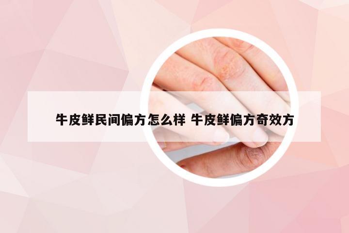 牛皮鲜民间偏方怎么样 牛皮鲜偏方奇效方