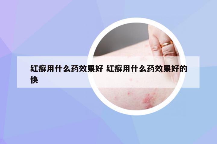 红癣用什么药效果好 红癣用什么药效果好的快