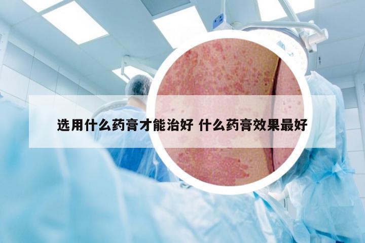 选用什么药膏才能治好 什么药膏效果最好