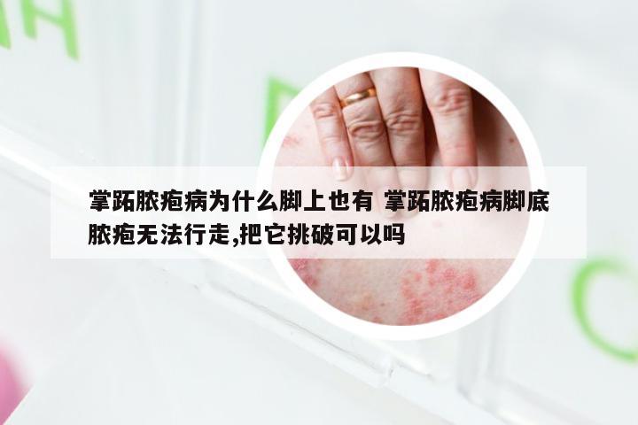 掌跖脓疱病为什么脚上也有 掌跖脓疱病脚底脓疱无法行走,把它挑破可以吗