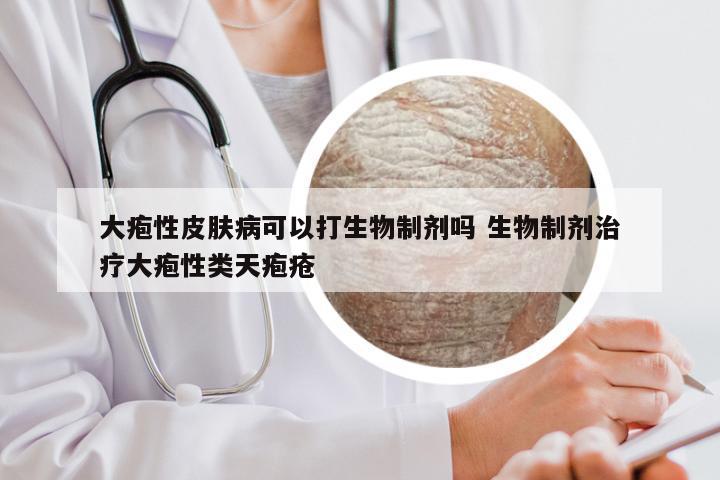 大疱性皮肤病可以打生物制剂吗 生物制剂治疗大疱性类天疱疮