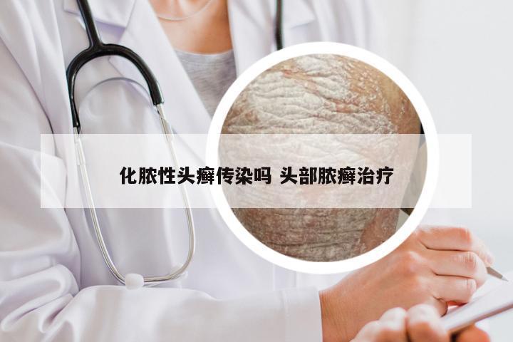 化脓性头癣传染吗 头部脓癣治疗