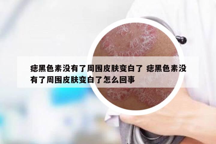 痣黑色素没有了周围皮肤变白了 痣黑色素没有了周围皮肤变白了怎么回事