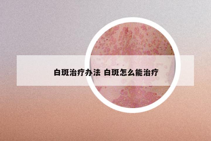 白斑治疗办法 白斑怎么能治疗