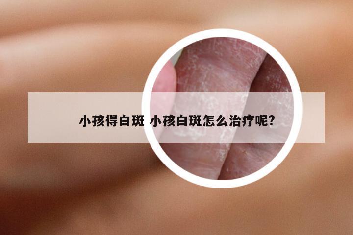 小孩得白斑 小孩白斑怎么治疗呢?