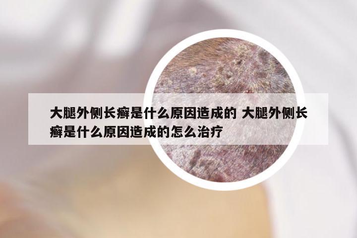 大腿外侧长癣是什么原因造成的 大腿外侧长癣是什么原因造成的怎么治疗