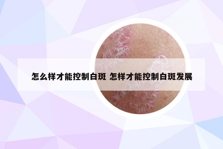 怎么样才能控制白斑 怎样才能控制白斑发展