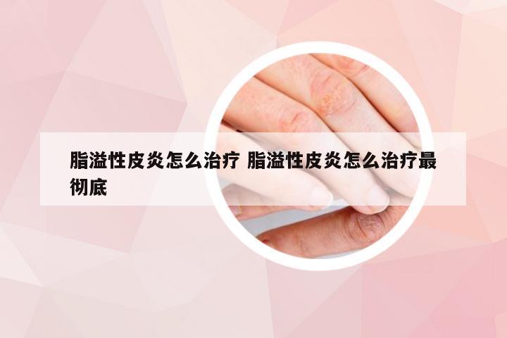 脂溢性皮炎怎么治疗 脂溢性皮炎怎么治疗最彻底