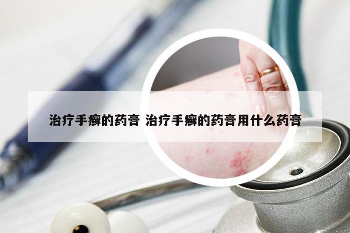 治疗手癣的药膏 治疗手癣的药膏用什么药膏