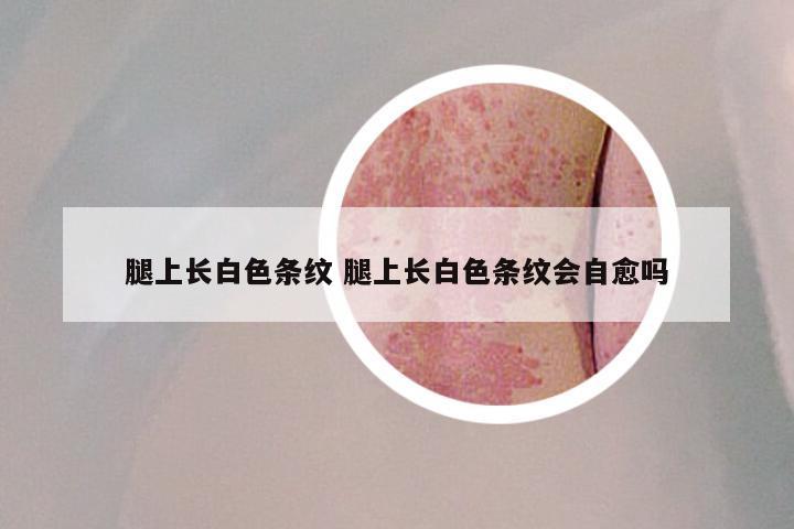 腿上长白色条纹 腿上长白色条纹会自愈吗