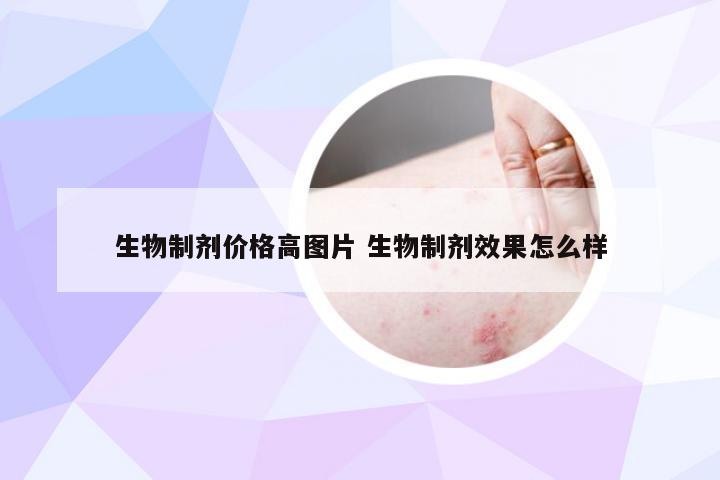 生物制剂价格高图片 生物制剂效果怎么样