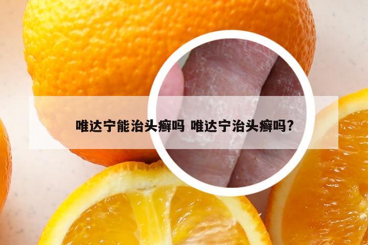 唯达宁能治头癣吗 唯达宁治头癣吗?