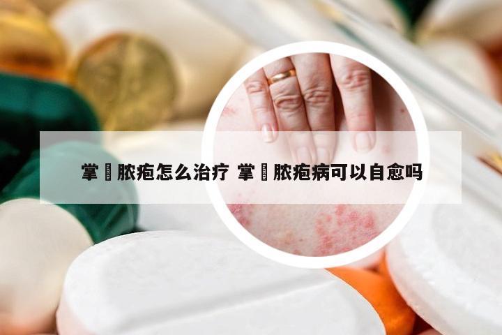 掌砳脓疱怎么治疗 掌砳脓疱病可以自愈吗