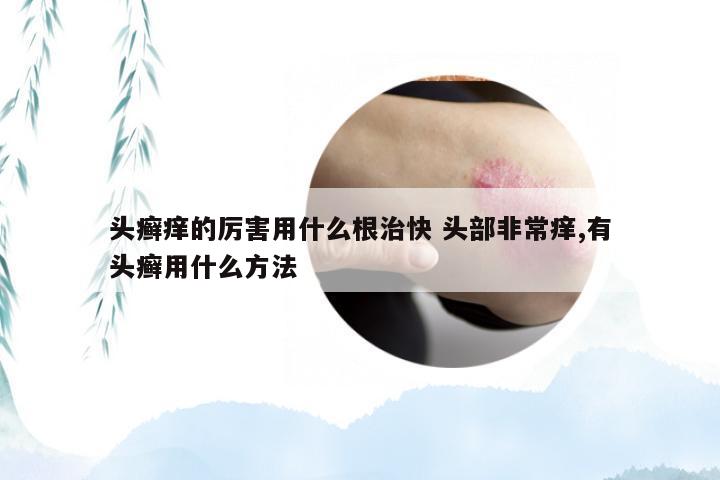 头癣痒的厉害用什么根治快 头部非常痒,有头癣用什么方法