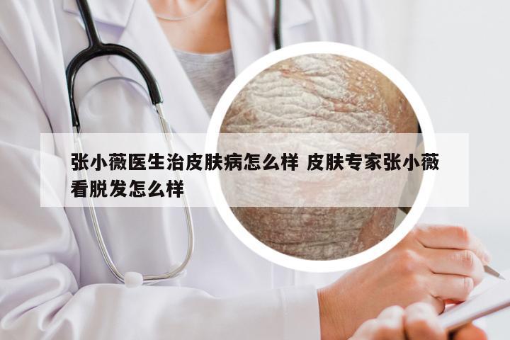 张小薇医生治皮肤病怎么样 皮肤专家张小薇看脱发怎么样