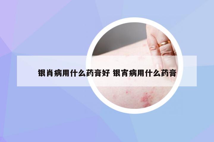 银肖病用什么药膏好 银宵病用什么药膏