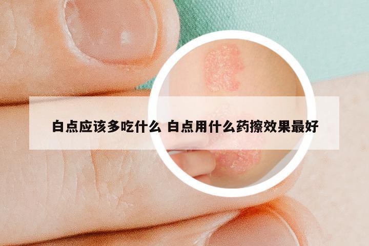 白点应该多吃什么 白点用什么药擦效果最好