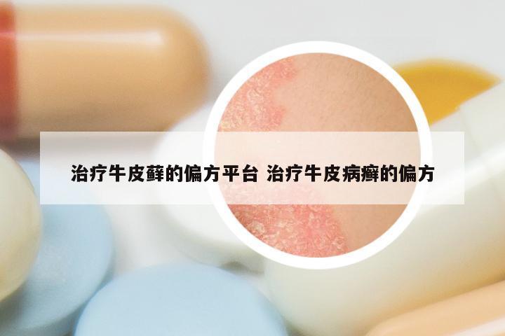 治疗牛皮藓的偏方平台 治疗牛皮病癣的偏方