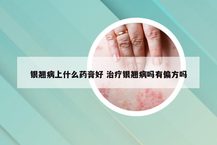 银翘病上什么药膏好 治疗银翘病吗有偏方吗