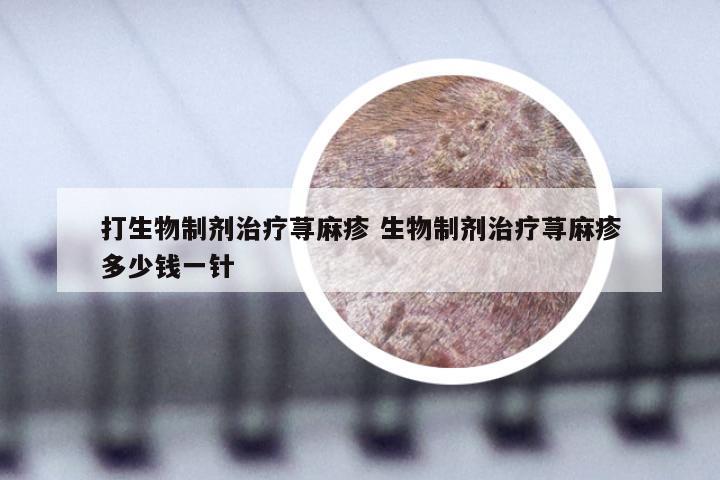 打生物制剂治疗荨麻疹 生物制剂治疗荨麻疹多少钱一针