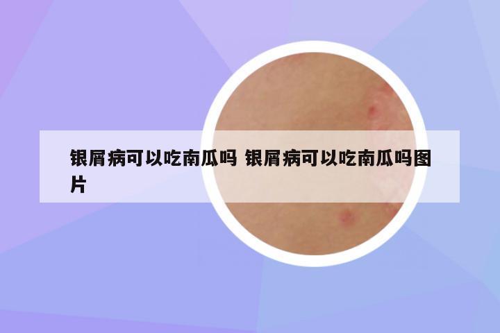 银屑病可以吃南瓜吗 银屑病可以吃南瓜吗图片