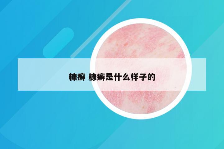 糠癣 糠癣是什么样子的