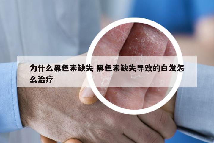 为什么黑色素缺失 黑色素缺失导致的白发怎么治疗