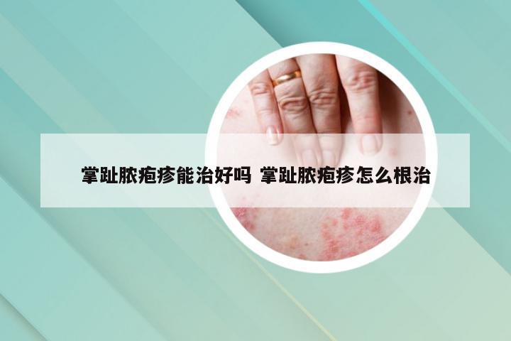 掌趾脓疱疹能治好吗 掌趾脓疱疹怎么根治