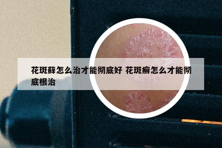 花斑藓怎么治才能彻底好 花斑癣怎么才能彻底根治